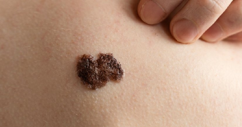 mole removal in bangalore